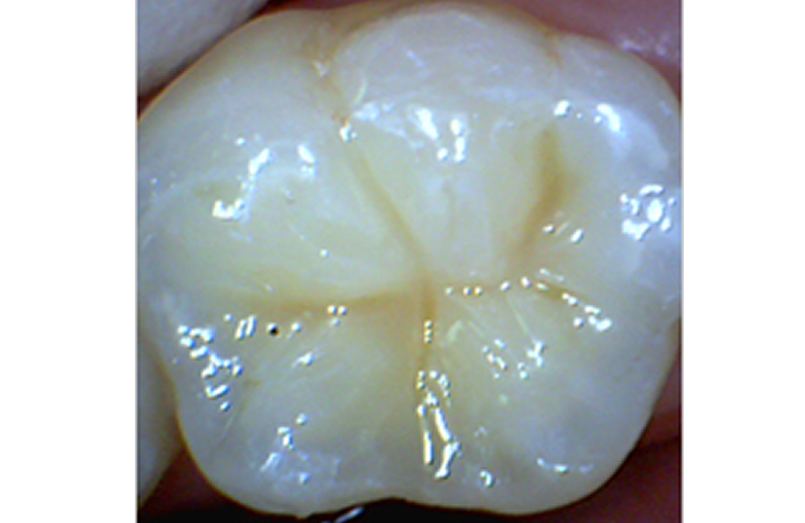 鴨宮　歯医者　保険適用のプラスチックで修復